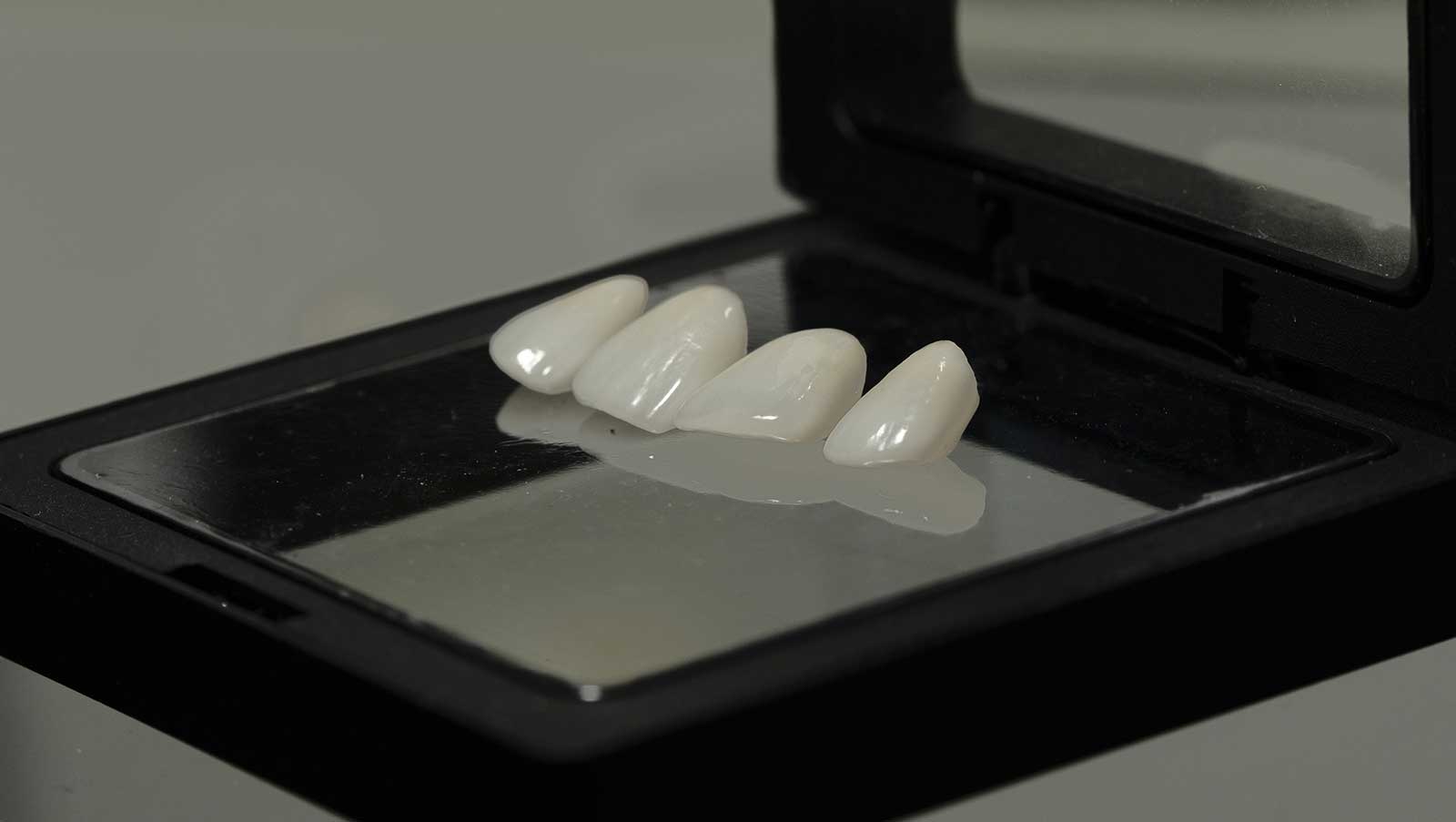 Dental Veneers