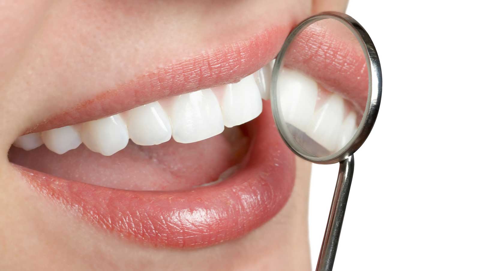 Teeth Whitening