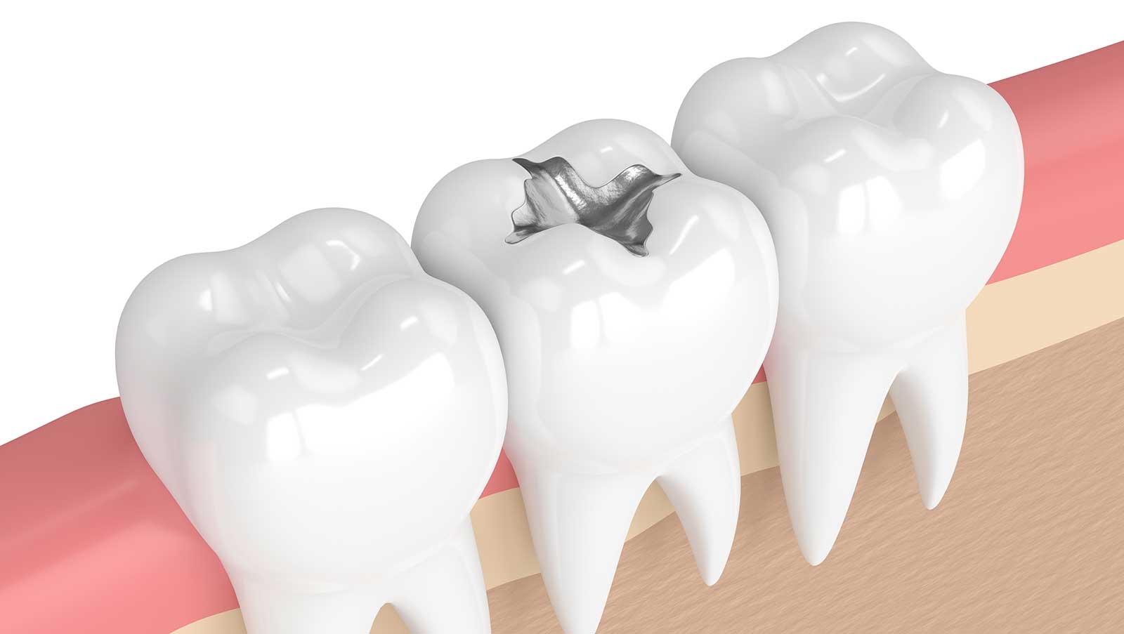 Tooth Fillings