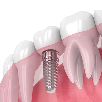 Dental Implant Restoration